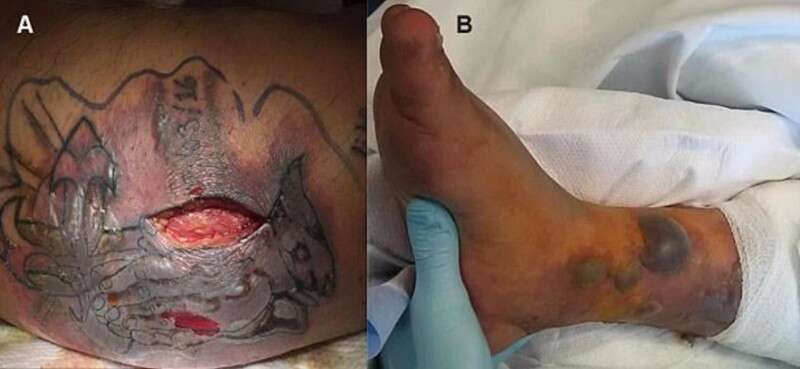 זיהום קשה בצורה בלתי רגילה // צילום: BMJ Case Reports